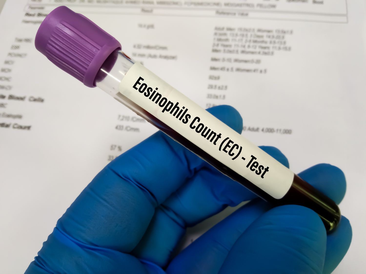 Eosinophil Migraine Link: Understanding Immune Triggers