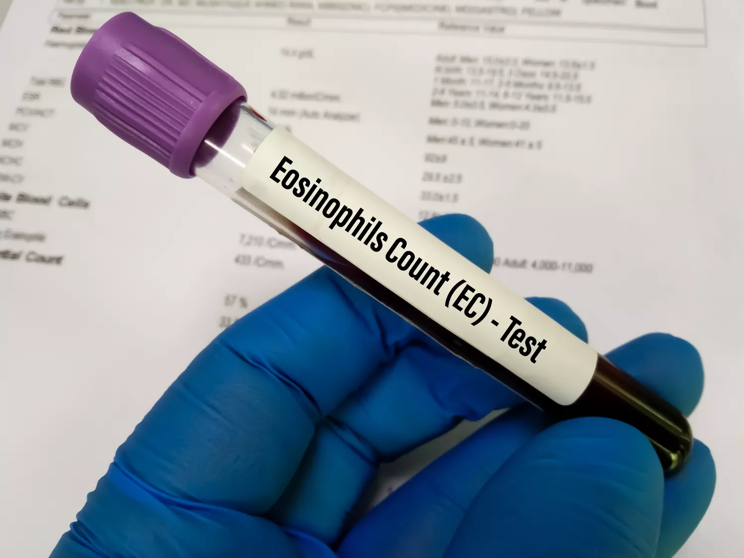Gloved hand holding a blood draw tube with the label 'eosinophils count (EC) test'.