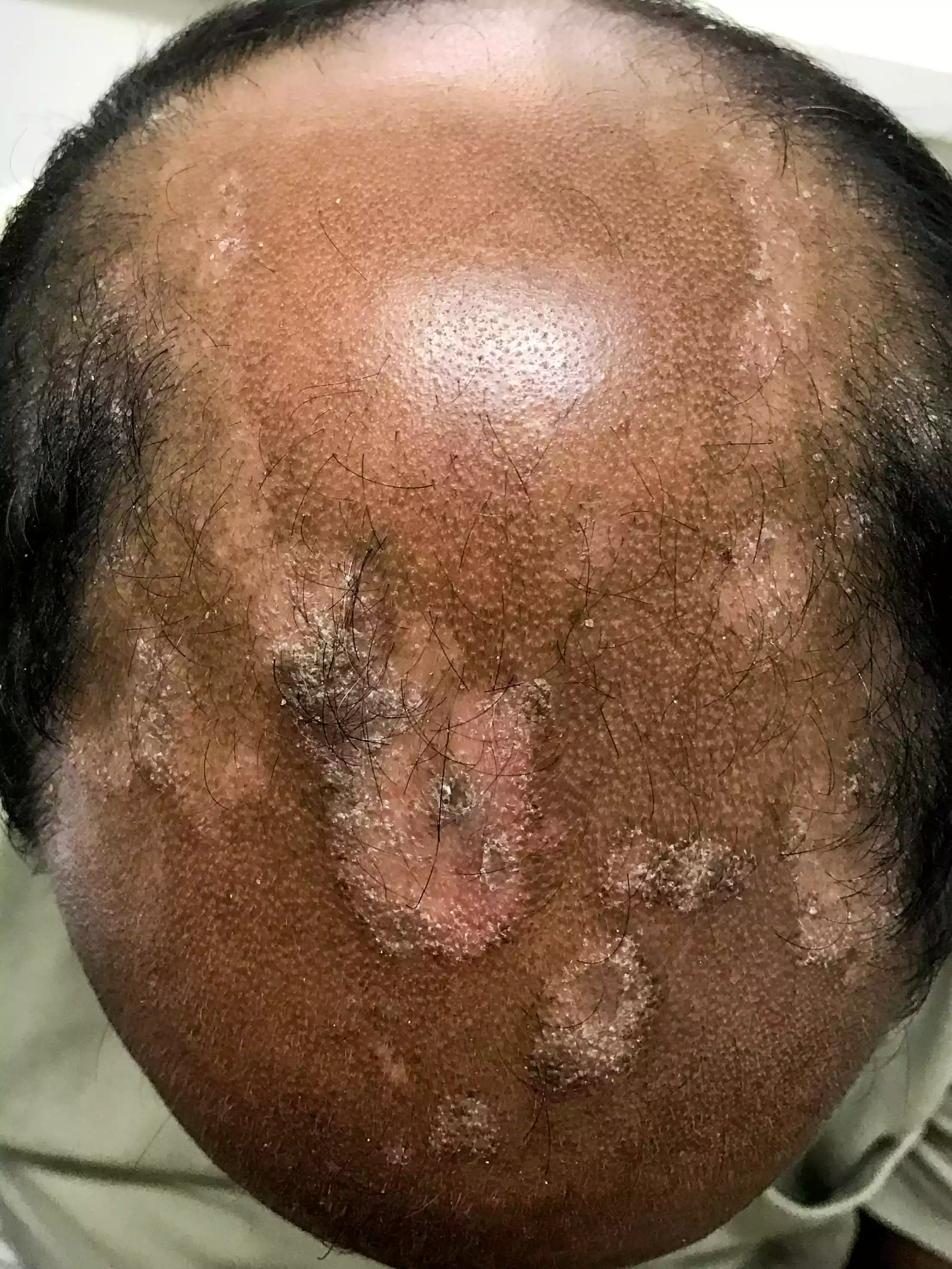 Close-up of psoriasis affecting the scalp and hairline with visible scaling.