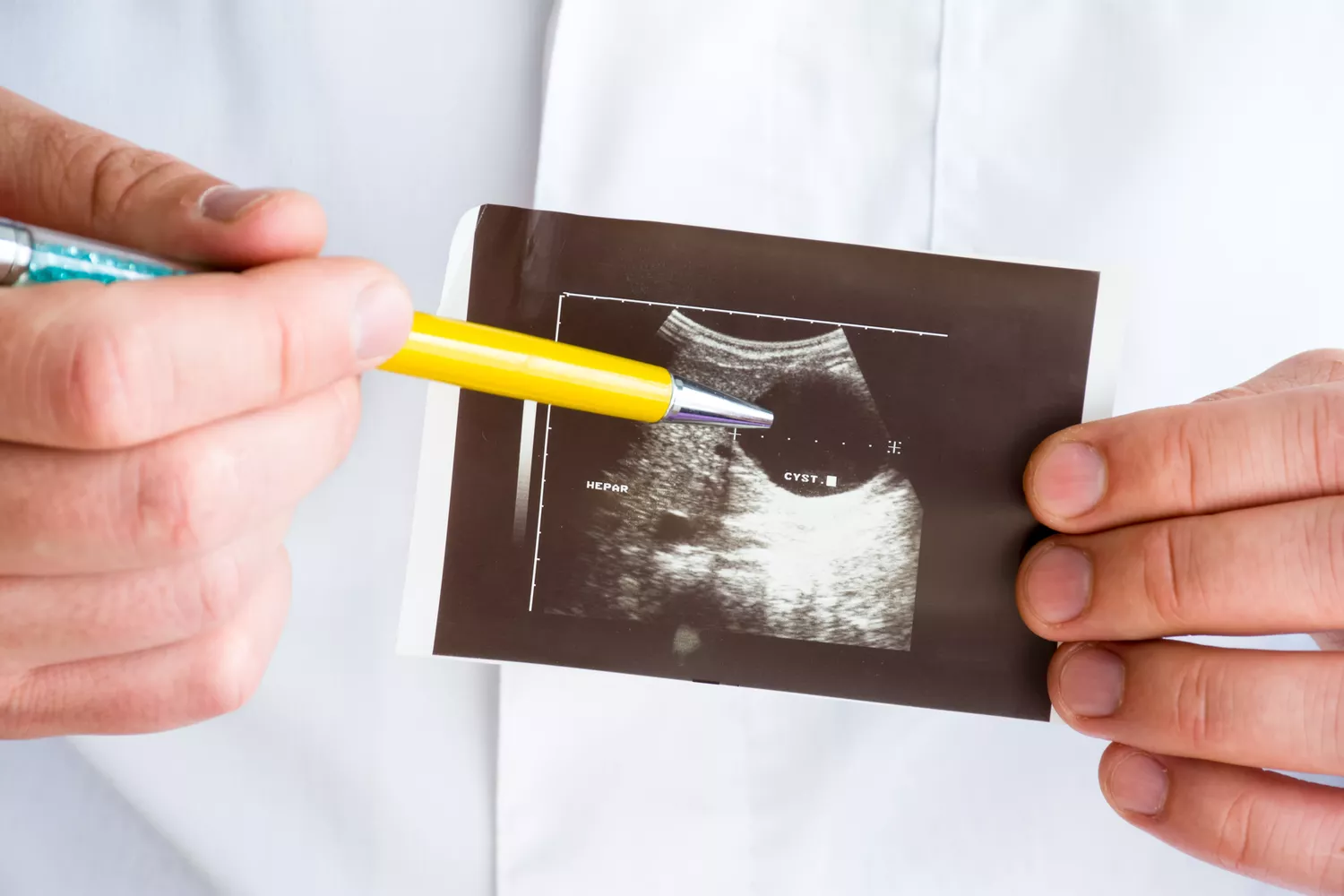 A healthcare provider pointing to a liver cyst shown on an ultrasound screen.