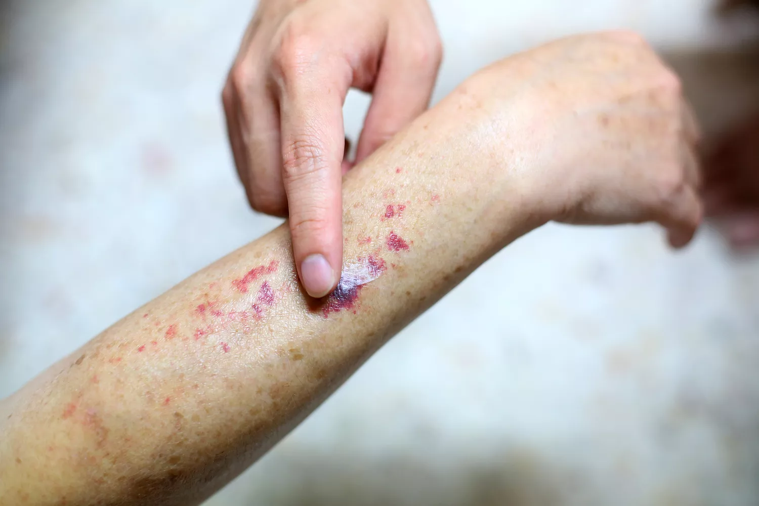 Petechiae rash appearing as small red spots on a person's arm.