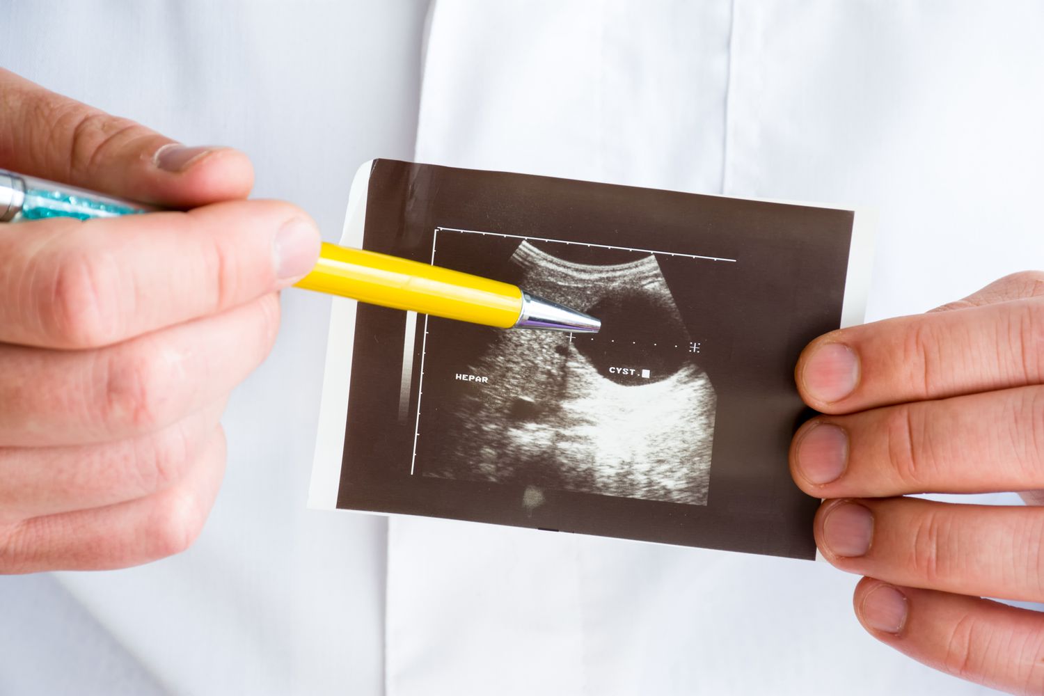 Liver Cysts: Size, Symptoms, and When to Worry