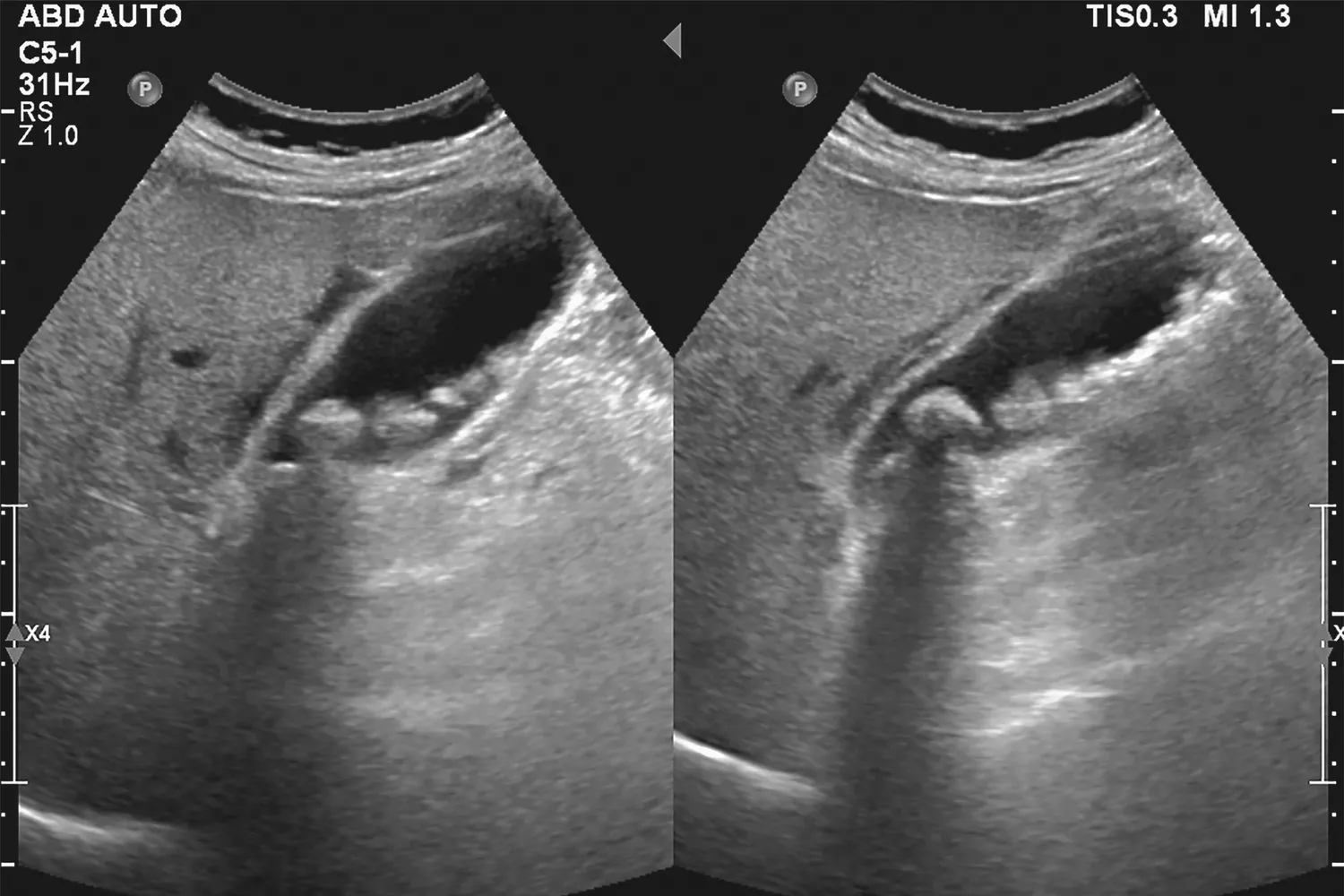 Diagnostic ultrasound image of a human gallbladder showing the presence of biliary sludge and small gallstones.