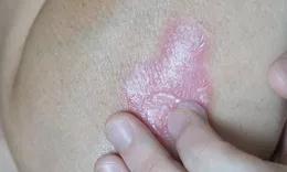 A person touching a pink, scaly psoriasis plaque on their torso, showing the texture of the lesion.
