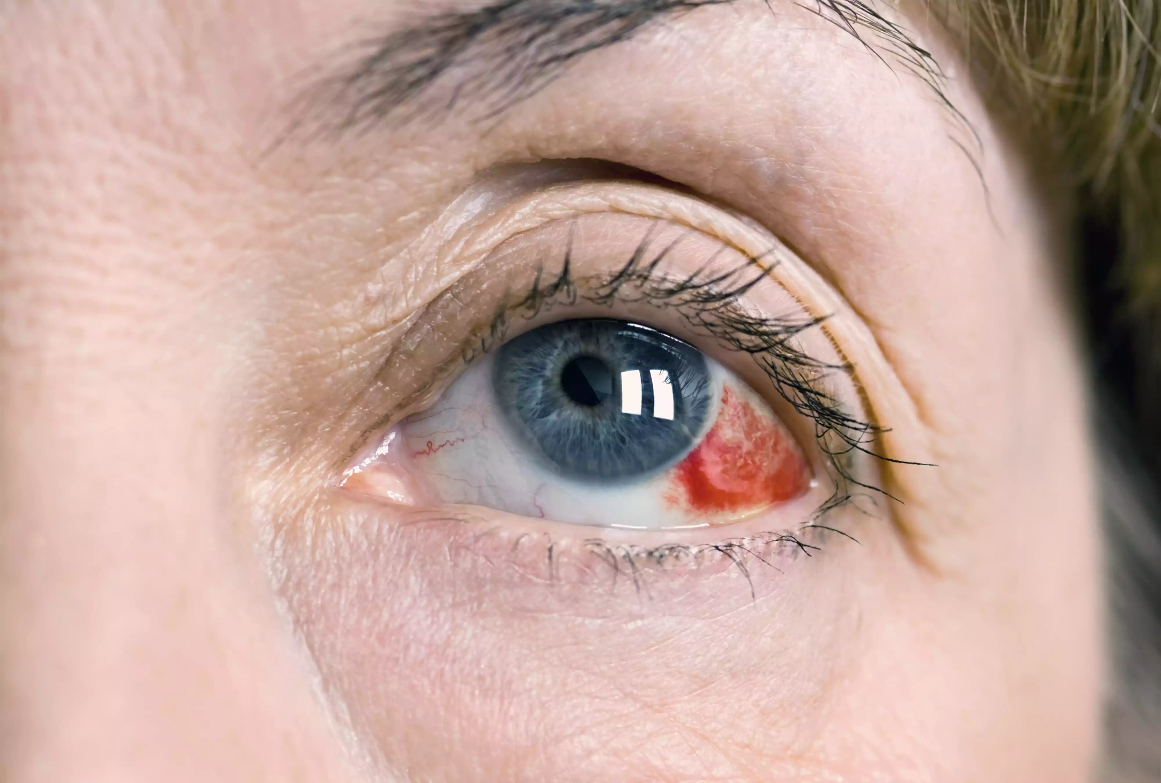 Close-up view of a subconjunctival hemorrhage in a patient's eye