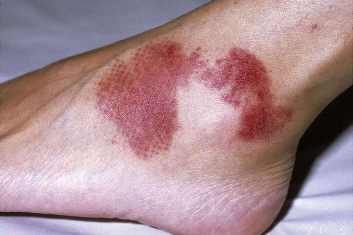 Purpura on the ankle and foot area.