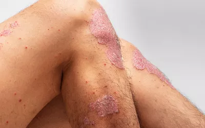 Frontal view of knees affected by red, scaly psoriasis plaques, illustrating rapid skin cell production.